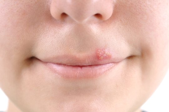 herpes treatment options